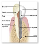 Structure of a dental implant