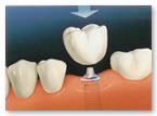 Dental implant
