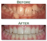 Orthodontic treatment - Before & After