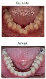 Orthodontic treatment - Before & After
