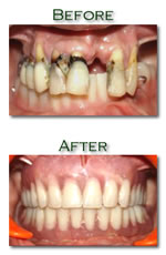 Proshtodontic treatment - Before and After image